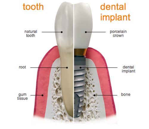 dental implant tooth illustration