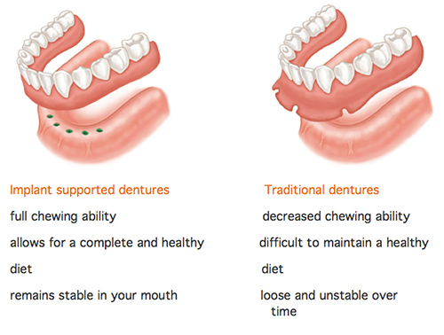 implant supported denture vs denture