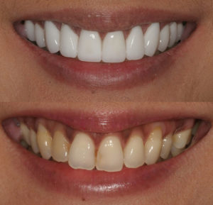 before and after cosmetic dentistry veneers before and after